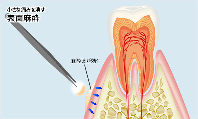 表面麻酔の使用