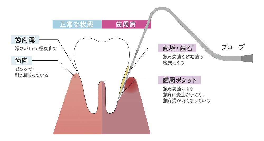 歯を失う原因第1位の「歯周病」