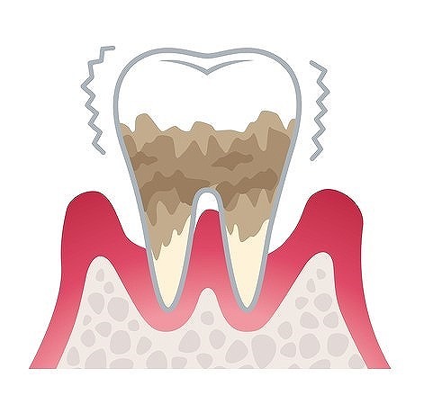 進行4　重度歯周炎