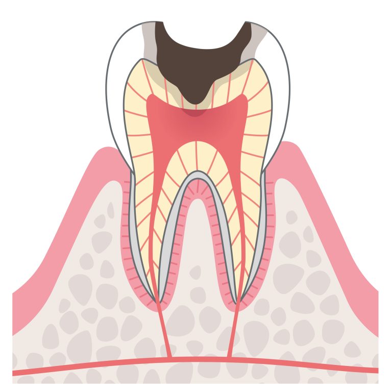 C3神経まで進⾏したむし歯