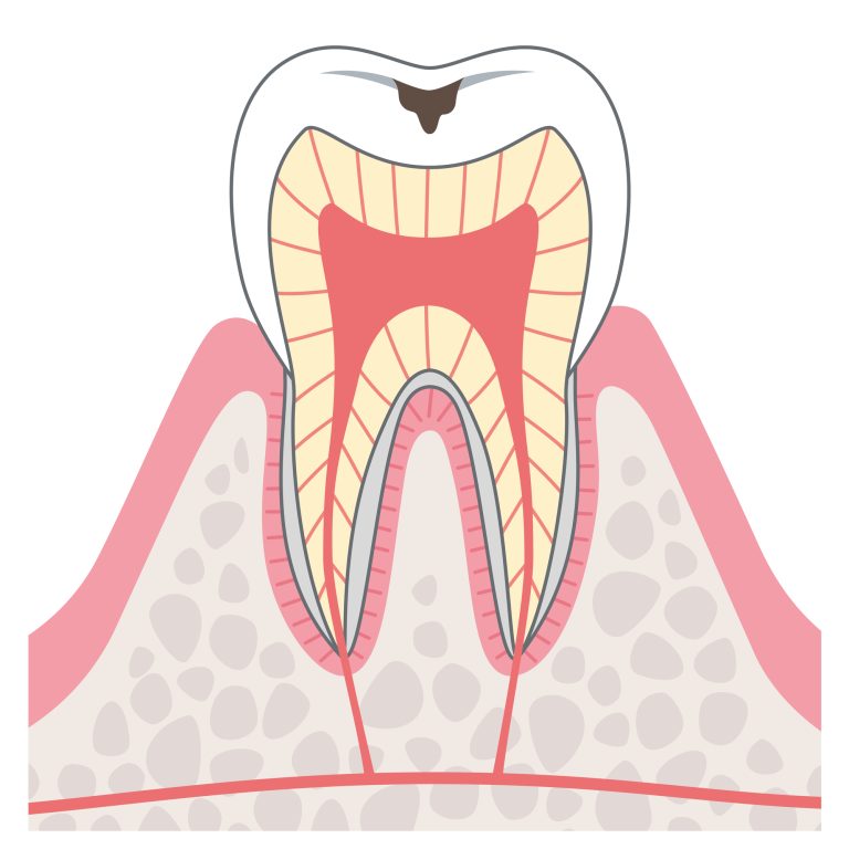 C1エナメル質のむし歯