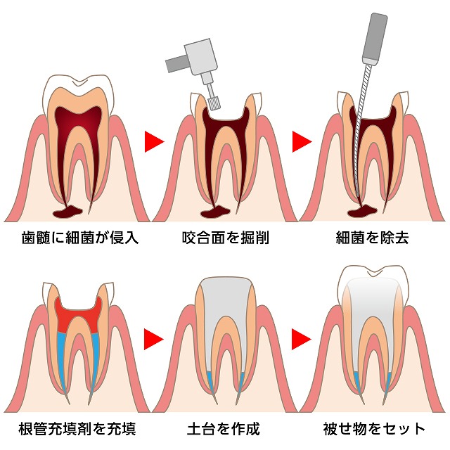 他院で抜歯と言われた方へ