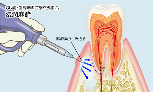 電動麻酔器の使用